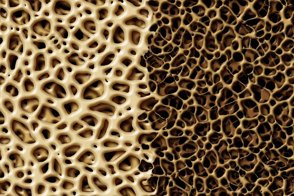 Osteoporosis: Risk Factors, Diagnosis, Prevention & Treatment