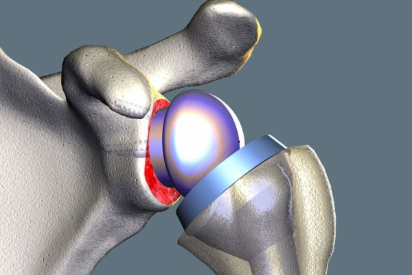 Total Shoulder Replacements