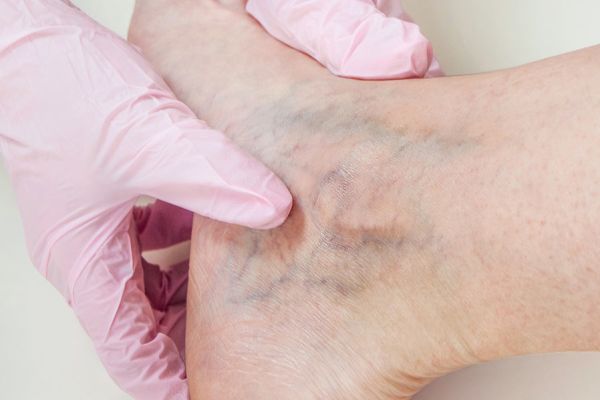 Vascular Care