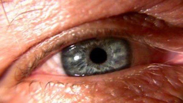 Dry Eye: Causes and Treatments